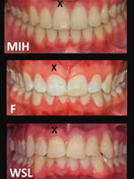Tänder MIH F WSL.png
